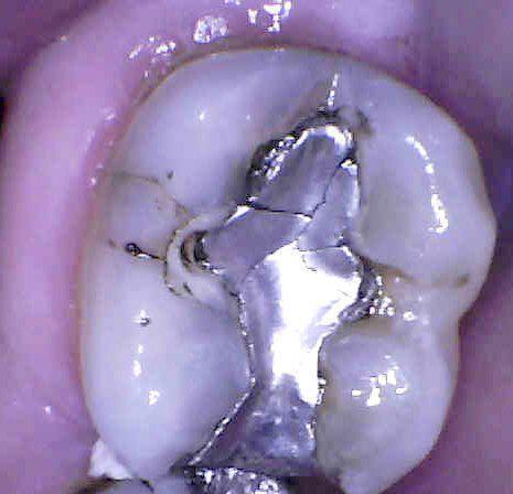 silver filling before | charlotte nc