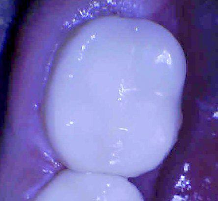 white fillings | charlotte nc